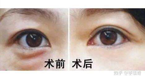 最新眼袋手术方法，与自然美景同行，探寻内心平静之旅
